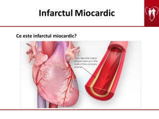 Boli de inimă: aritmii și infarct miocardic